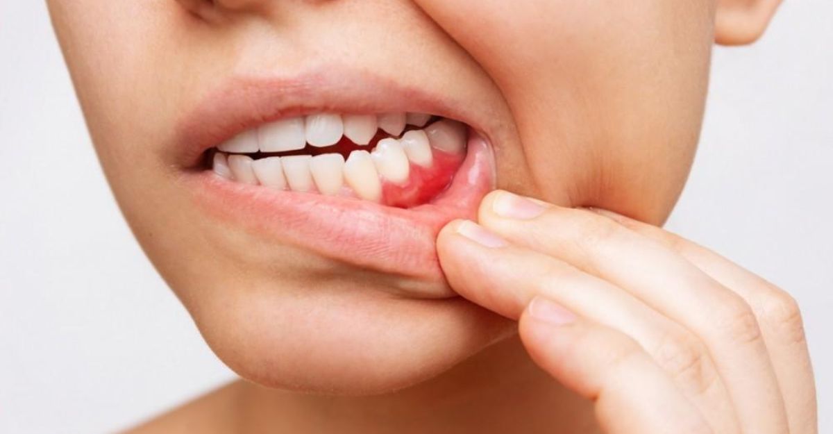 how-to-relieve-swollen-gums