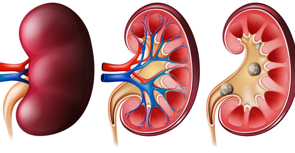 how-to-relieve-pain-with-kidney-stones
